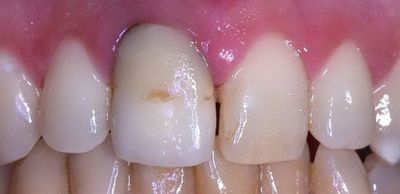 CAD/CAM 制作前后